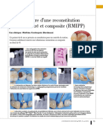 Reconstitutionpar Tenon Fibré Et Composite