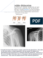 Shoulder Dislocation