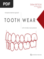 Tooth Wear