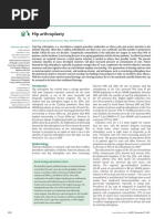 Hip Arthroplasty Lancet