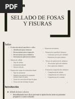 T1. Sellado de Fosas y Fisuras