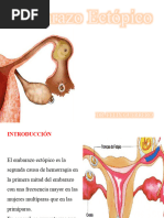 Embarazo-Ectopico-presentacion Tercera Seman