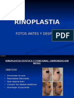 Rinoplastia Power Point