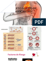 Infarto Agudo de Miocardio