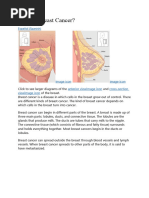 Types of Breast Cancer