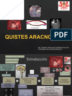 Quistes Aracnoideos