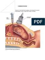 CORDOCENTESIS