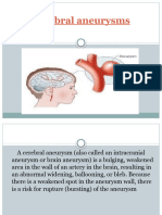 Cerebral Aneurysms