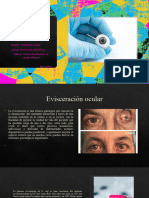 Evisceración Ocular