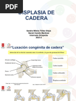 Displasia de Cadera