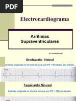 Arritmias Supraventriculares y Ventriculares