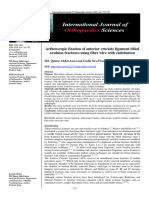 Arthroscopic Fixation of Anterior Cruciate Ligament Tibial Avulsion Fractures Using Fibre Wire With Endobutton