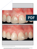 The Connective Tissue Platform Technique For Soft Tissue Augmentation. Zucchelli, 2012 .En - Es