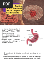 Úlcera Gástrica