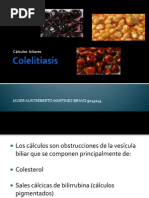 Colecistitis y Colelitiasis