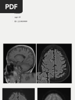 Cerebral Cavernous Malformation