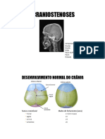 Craniostenose