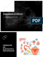 Embarazo Ectopico