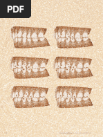 Class II Subdivision Treatment With Distalization Using Invisalign - Case Report