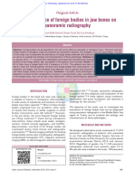 The Prevalence of Foreign Bodies in Jaw Bones On P