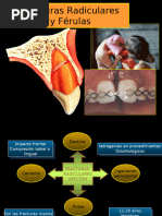 Fracturas Radiculares y Ferulas