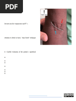 Brachial-Cephalic Fistula Creation