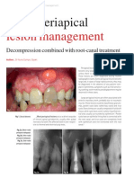 Large Lesion Management - Roots0112