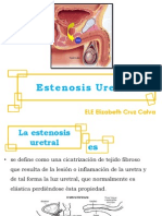 Estenosis Uretral