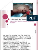 Trauma de Torax