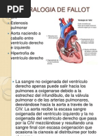 Tetralogia de Fallot