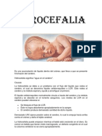 Hidrocefalia