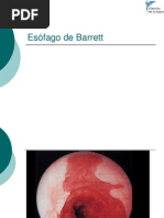 Esófago de Barrett