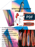 Angioplastia y Colocación de Stent