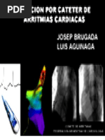 Ablacion Cateter Arritmias Cardiacas