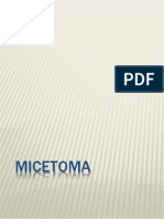 Micetoma