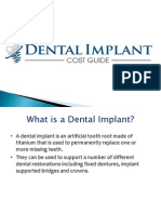 Guide To Dental Implants Cost and Procedure