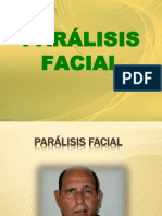 Parálisis Facial