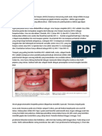 Acute Gingivo Stomatitis