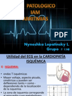 Arritmias Cardiaca