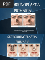 Septorrinoplastia