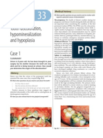 Tooth Discoloration Hypomineralization and Hypoplasia