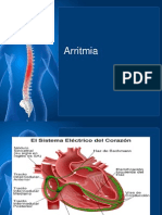 Arritmia Cardiaca