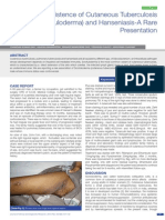 Coexistence of Cutaneous Tuberculosis (Scrofuloderma) and Hanseniasis-A Rare Presentation