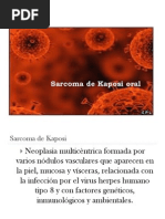 Sarcoma de Kaposi Oral