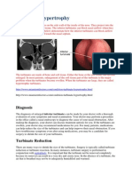 Turbinate Hypertrophy