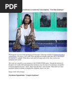 Epidermodysplasia Verruciformis, Lewandowsky-Lutz Dysplasia, "Tree Man Syndrome"