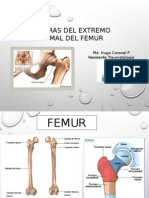 Fracturas Trocantereanas de Femur