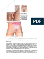 Hernia Inguinal