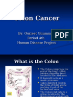 Colon Cancer