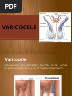 Varicocele